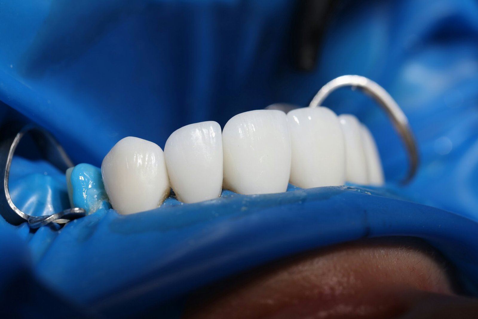 Dental Crownsin Turkey