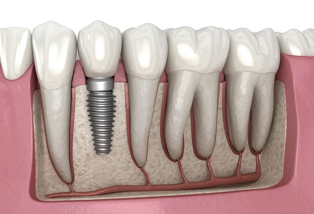 Dental Implantsin Turkey