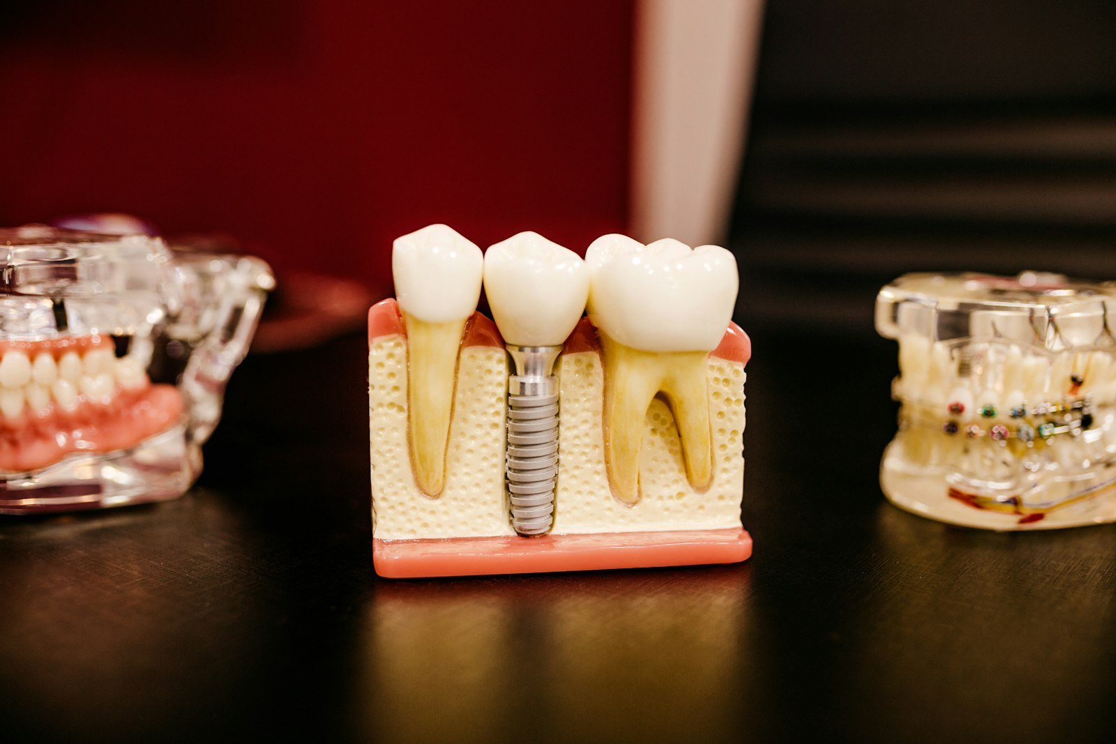 Dental Implants in Turkey