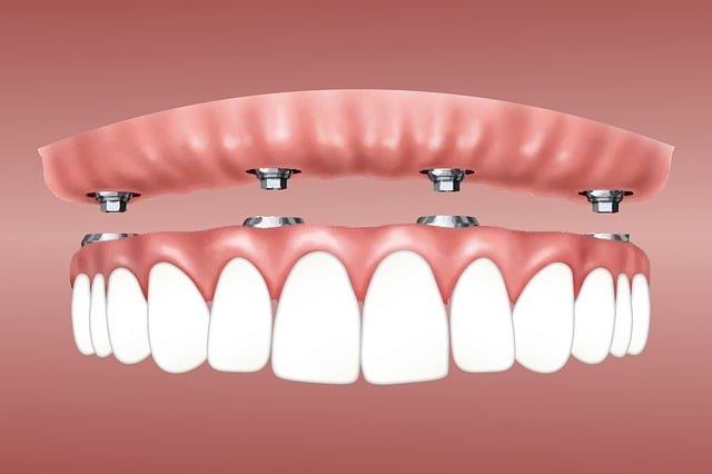Why Choose Dental Implants in Turkey?