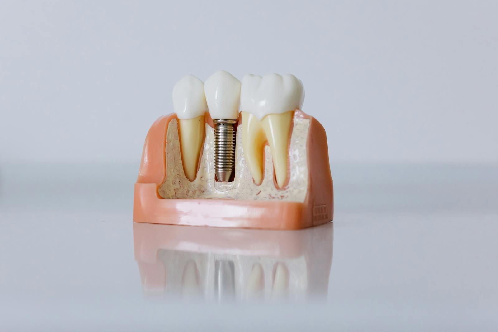 Am I Suitable for Dental Implants?
