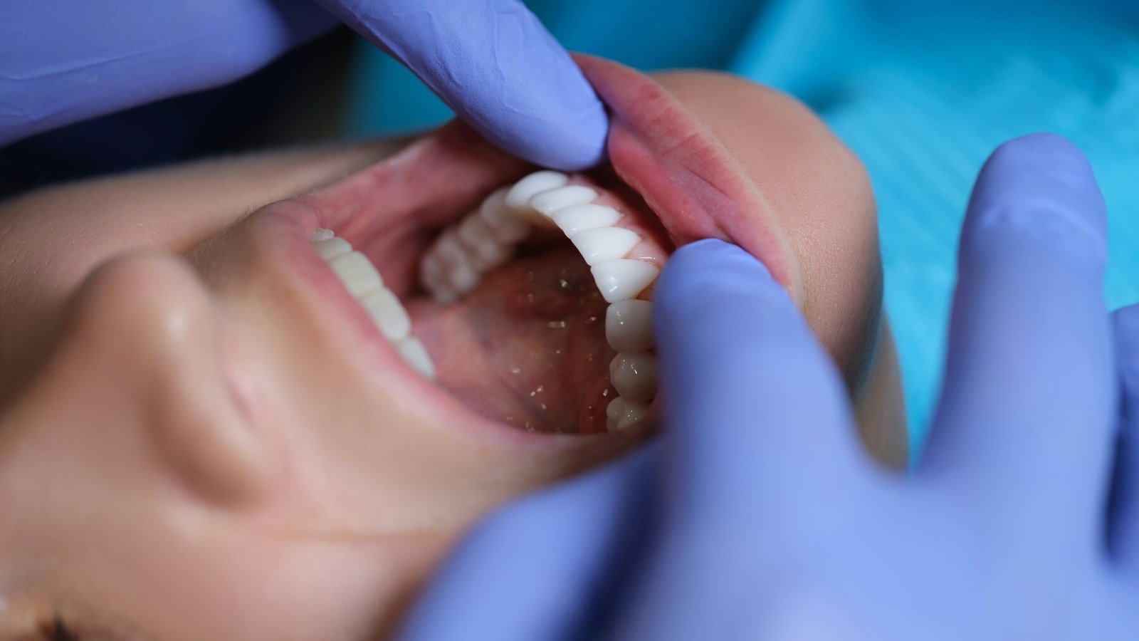 Dental Veneersin Turkey