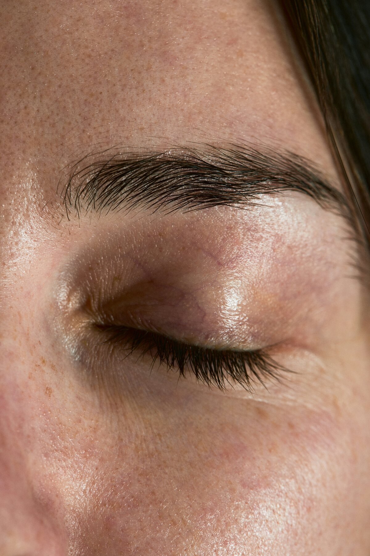 Eyelid Surgeryin Turkey