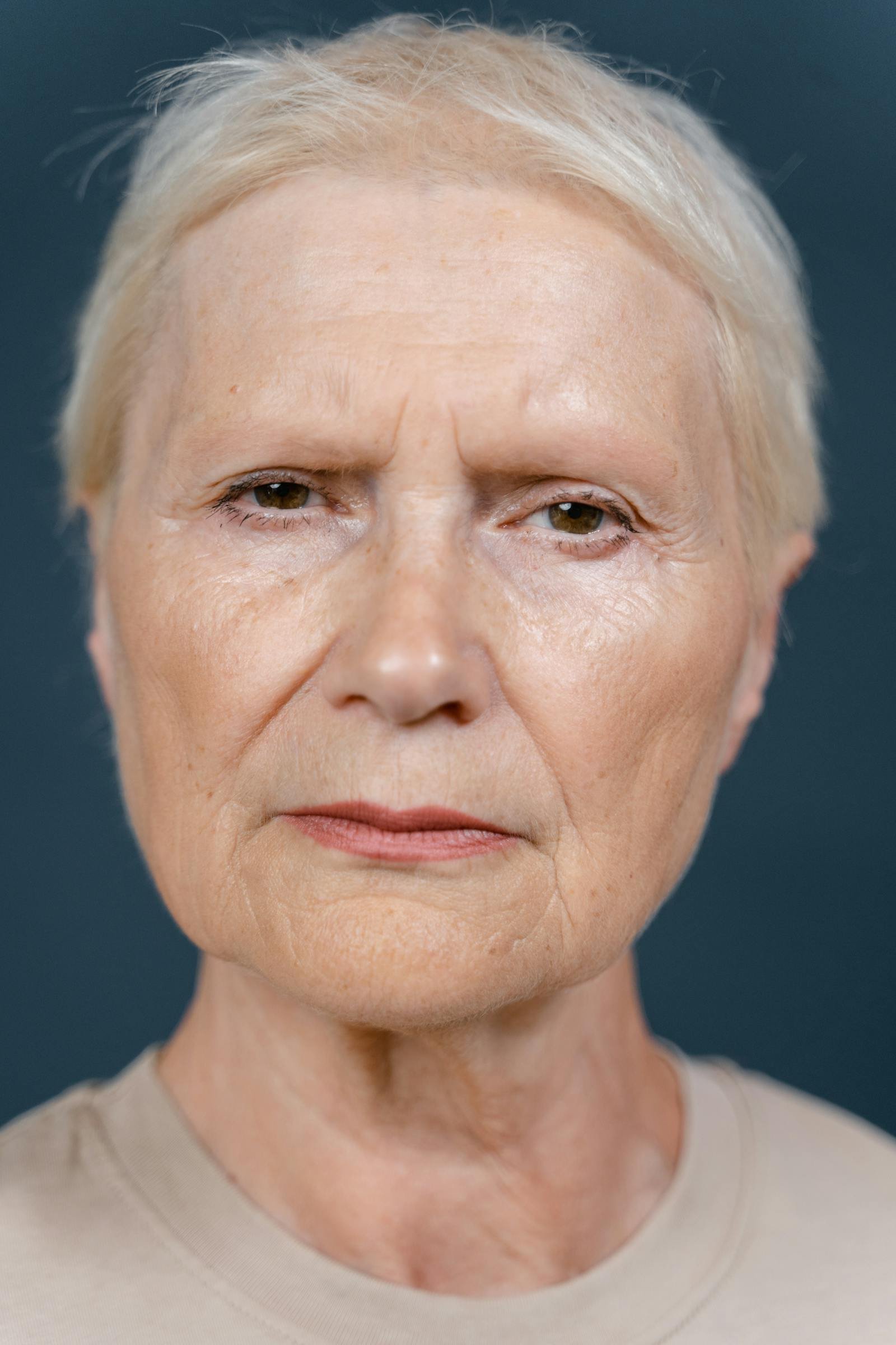 Face-Neck Lift in Turkey