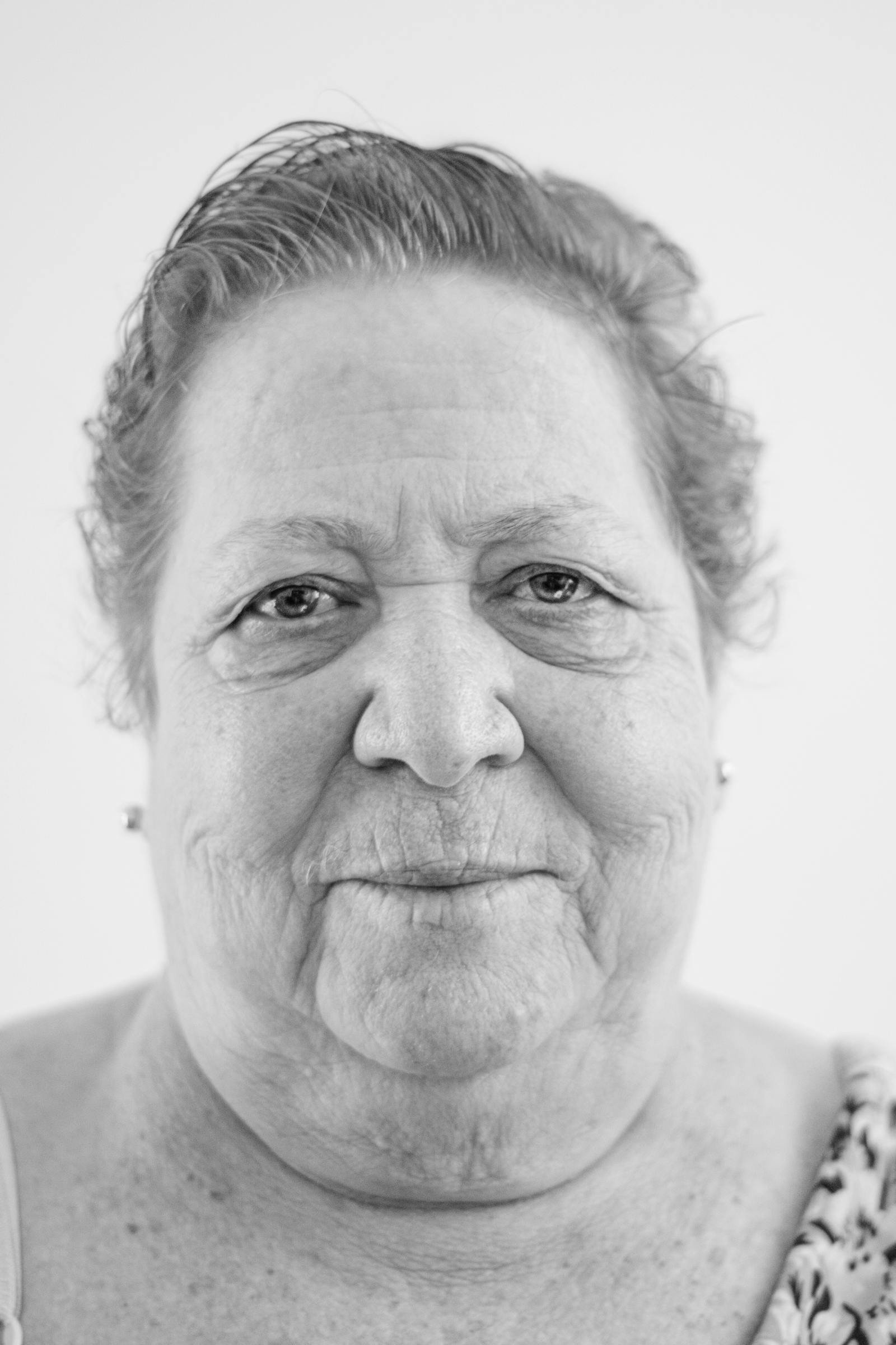 Am I Suitable for a Face Lift?