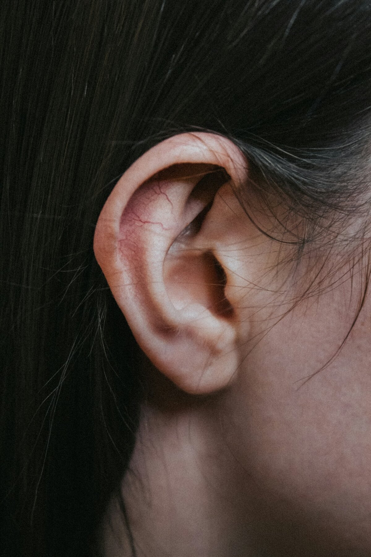 Ear Surgery (Otoplasty)in Turkey