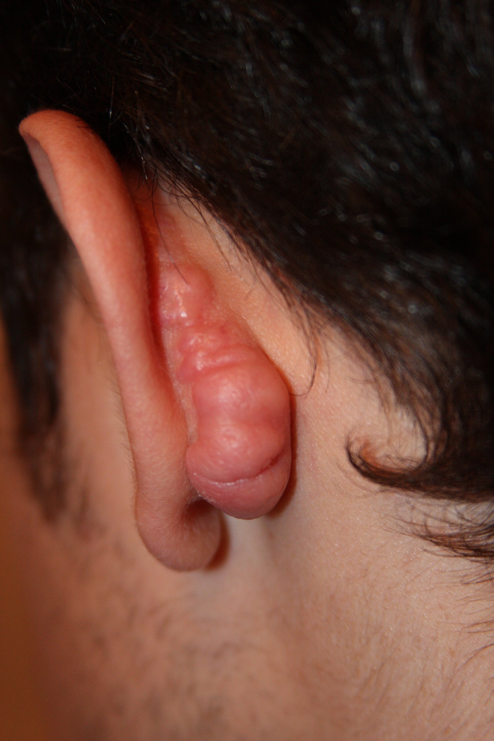 Otoplasty in Turkey