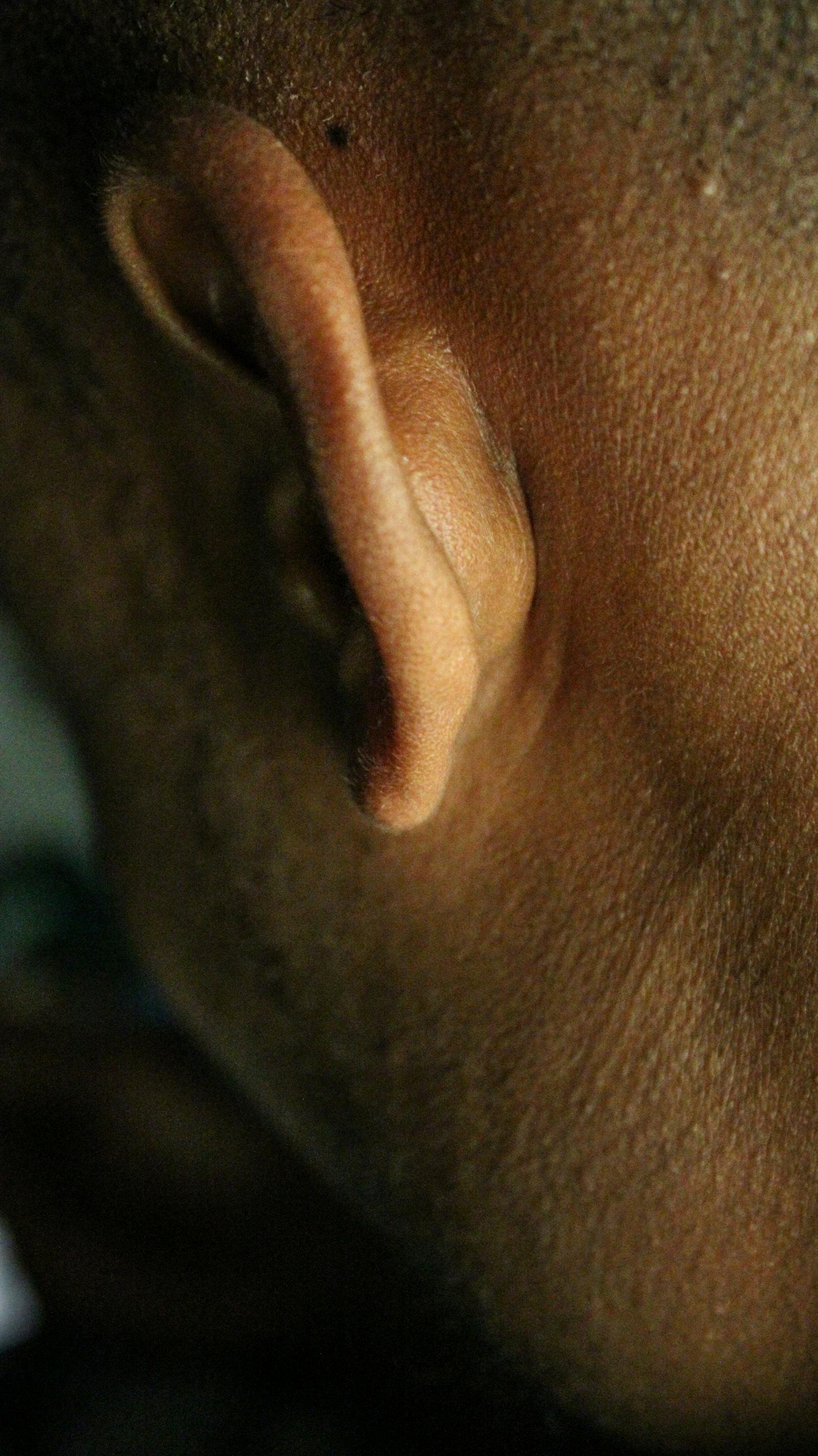 Am I Suitable for Otoplasty?